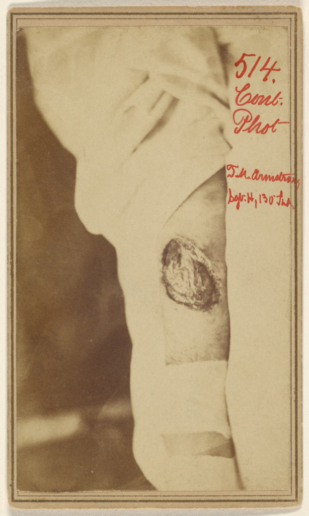 Unknown maker, American:[Leg wound of Thomas M. Armstrong, C, Poster Print Wall Art