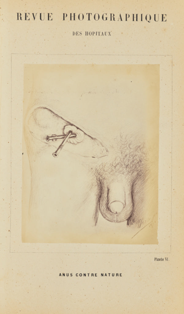 A. de Montmeja:Anus contre nature, Poster Print Wall Art