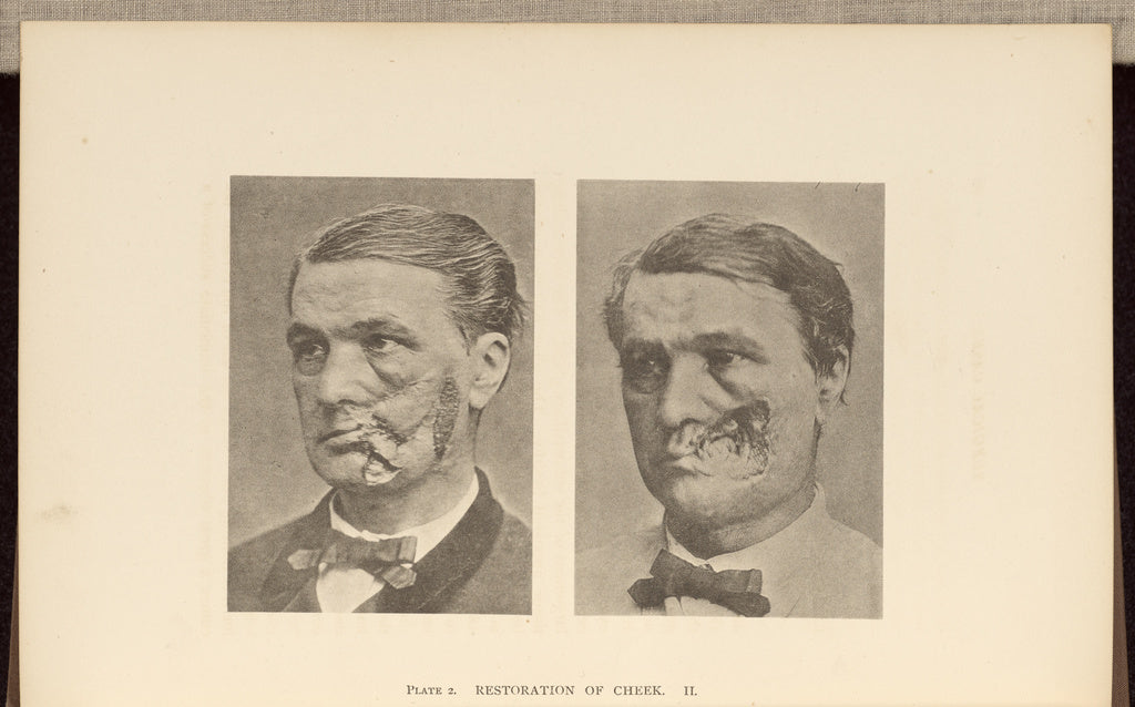Charles B. Brigham:Restoration of Cheek, Poster Print Wall Art