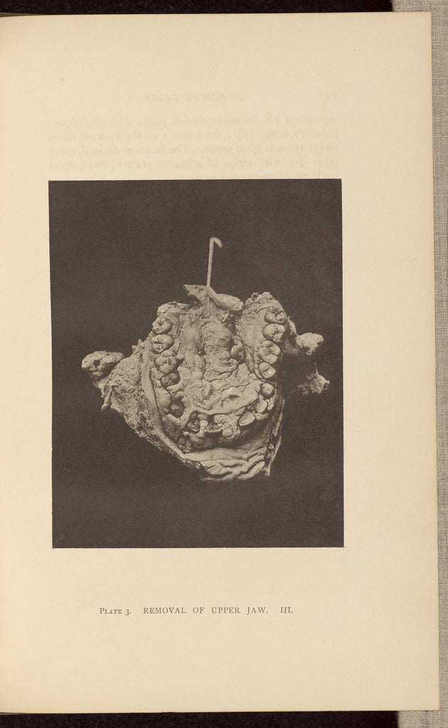 Charles B. Brigham:Removal of Upper Jaw, Poster Print Wall Art