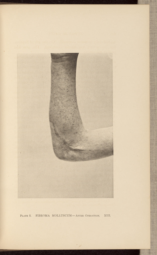 Charles B. Brigham:Fibroma Molluscum - After Operation, Poster Print Wall Art
