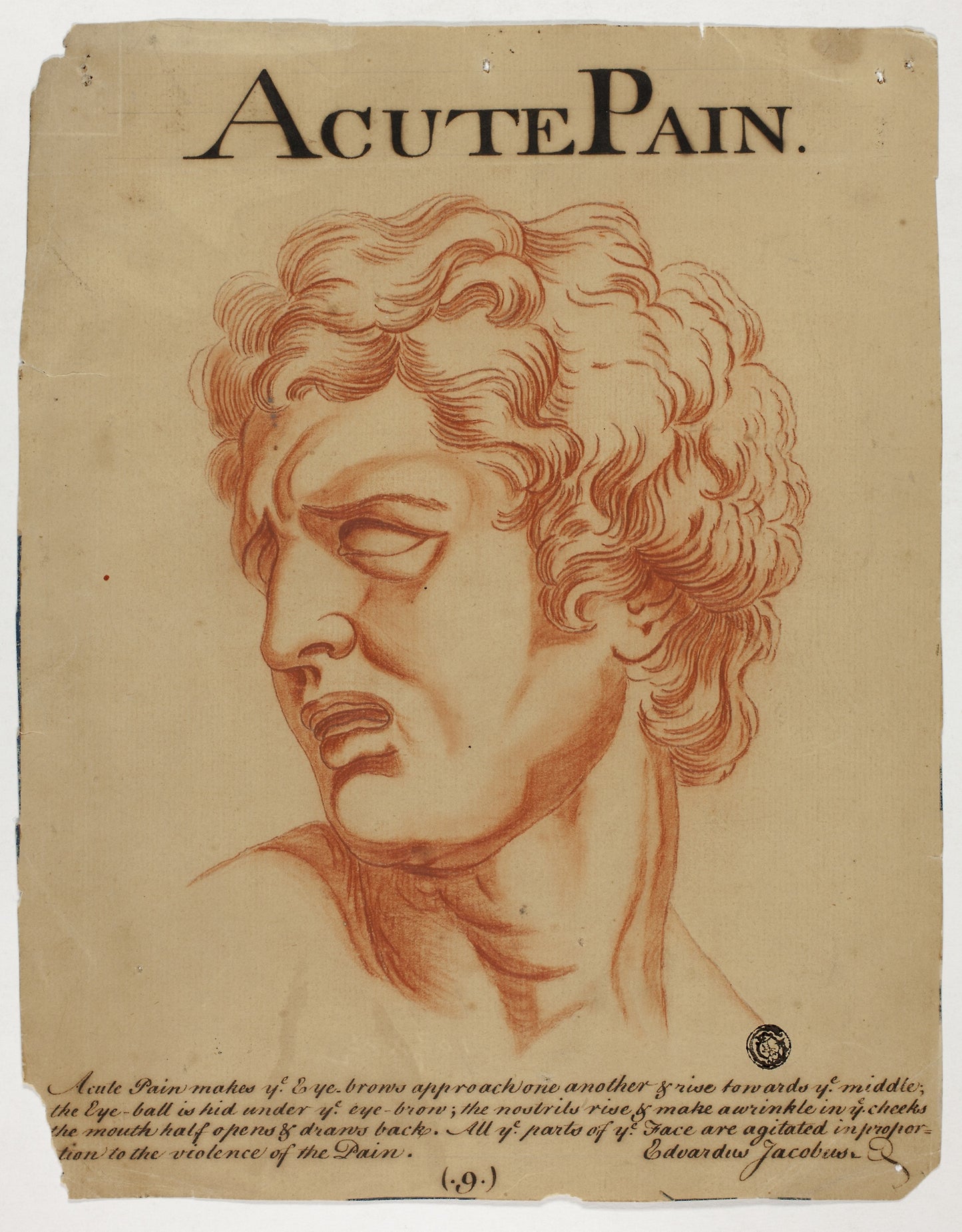 Acute Pain - Eduardus Jacobus (British, 18th century), Poster Print Wall Art