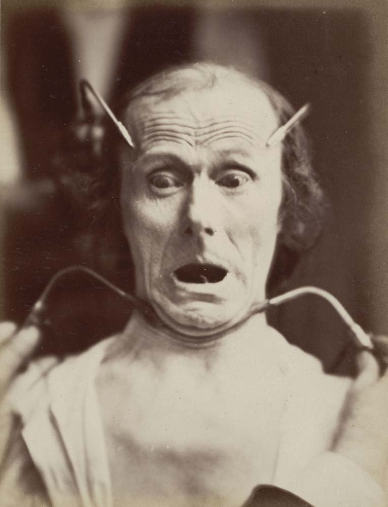 Guillaume-Benjamin-Armand Duchenne de Boulogne - Fright from Mechanics of Human Physiognomy, vintage historic photograph, modern poster print