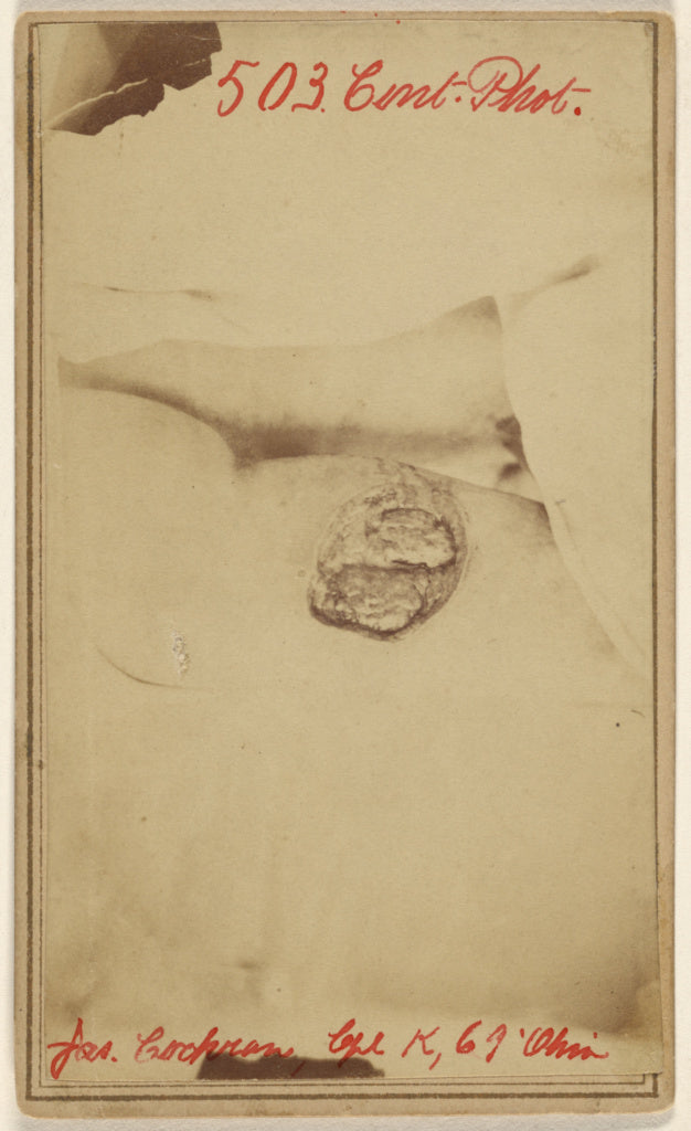 Unknown maker, American:[Thigh wound of James Cochran, Civil, Poster Print Wall Art
