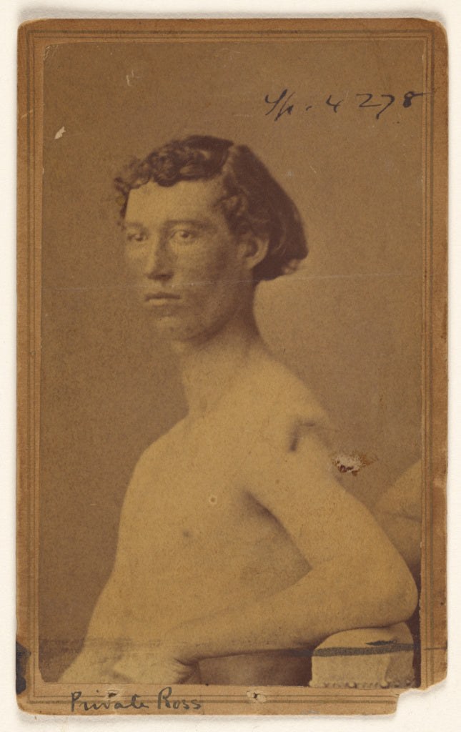 William H. BellAttributed to:Private Ross [Civil War victim], Poster Print Wall Art