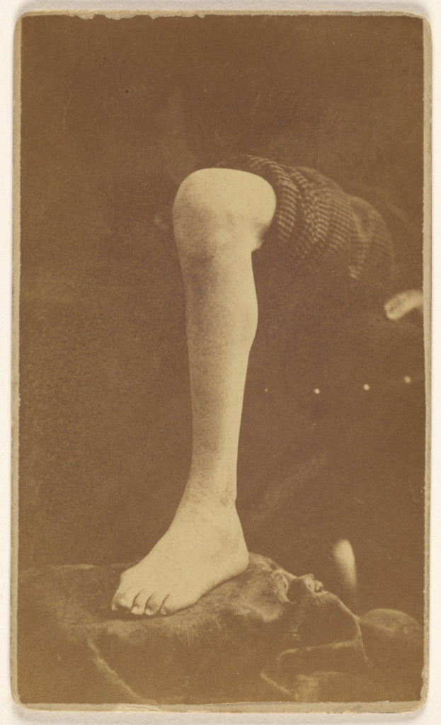 J. Dennison:Excision ankle joint Pt. Robert Fuller 45th Ill., Poster Print Wall Art