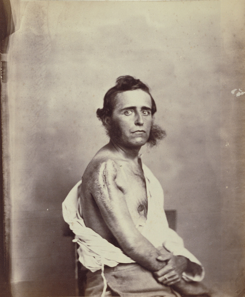 William H. BellPossibly:Successful Intermediate Excision of , Poster Print Wall Art