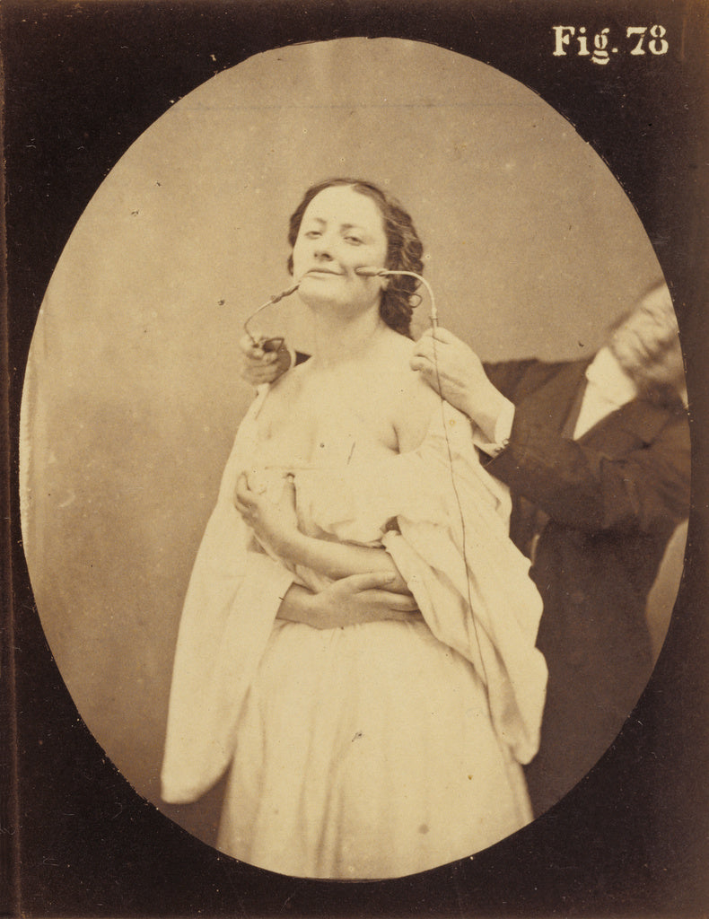 Guillaume-Benjamin Duchenne:Electro-physiologie Photographiq, Poster Print Wall Art