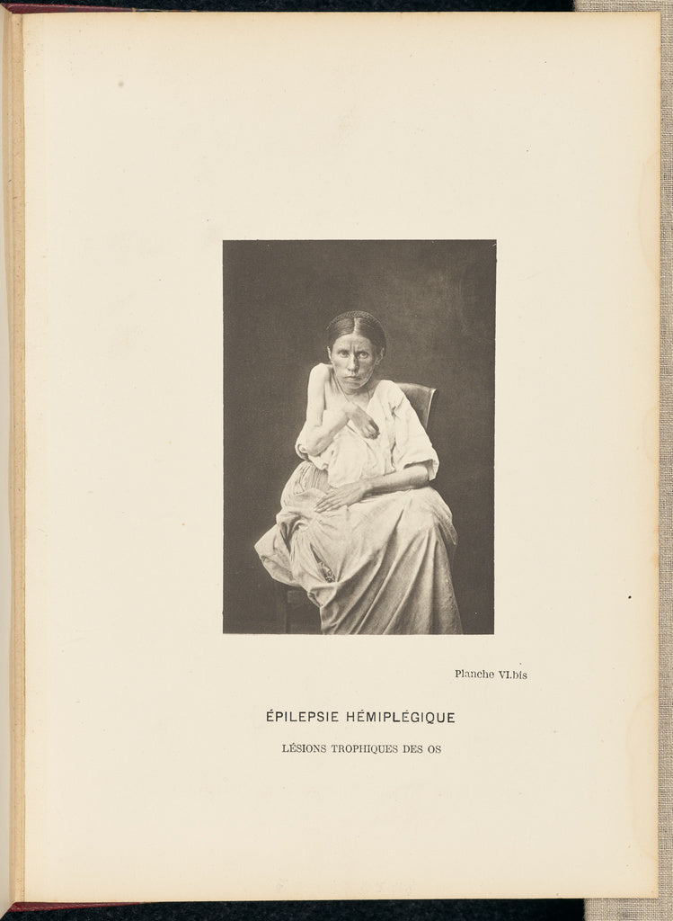 André Adolphe-Eugène Disdéri:Epilepsie Hémiplégique Lésio,16x12"(A3)Poster