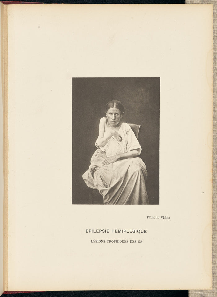 André Adolphe-Eugène Disdéri:Epilepsie Hémiplégique Lésio,16x12