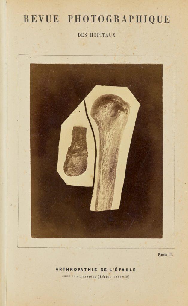 A. de Montmeja:Arthropathie de l'épaule, chez une ataxique , Poster Print Wall Art