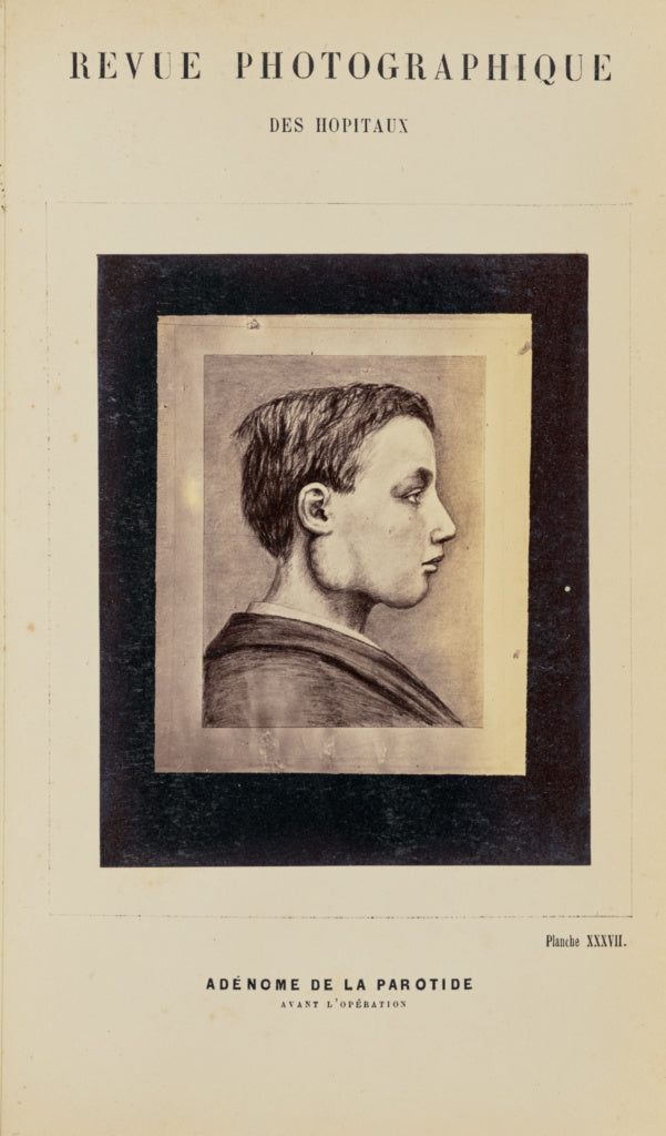 A. de Montmeja:Adénome de la parotide, avant l'opération, Poster Print Wall Art
