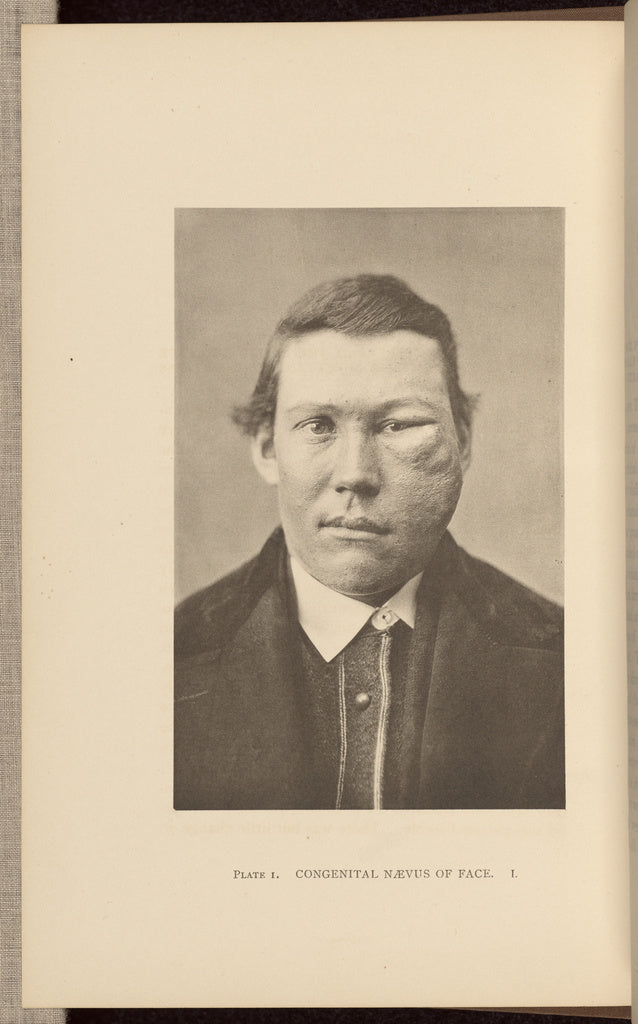 Charles B. Brigham:Congenital Nævus of Face, Poster Print Wall Art