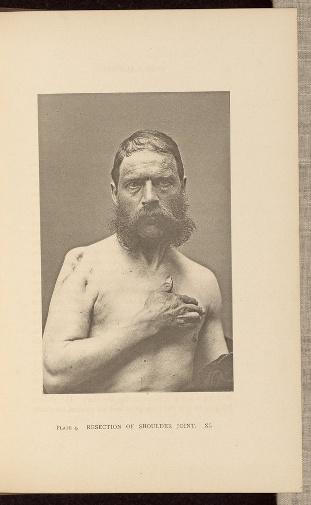 Charles B. Brigham:Resection of Shoulder Joint, Poster Print Wall Art