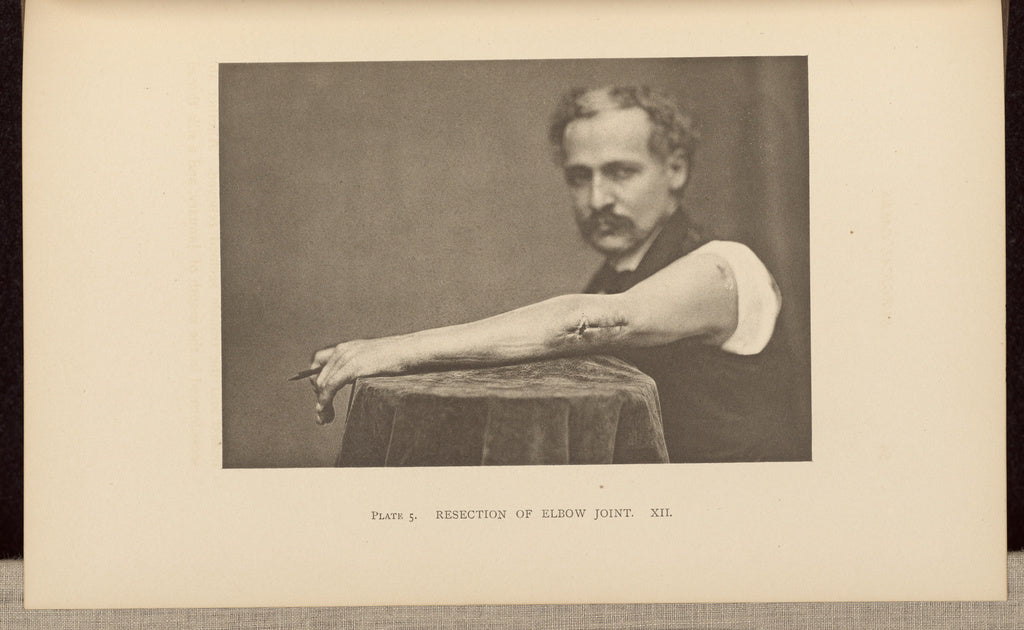 Charles B. Brigham:Resection of Elbow Joint, Poster Print Wall Art