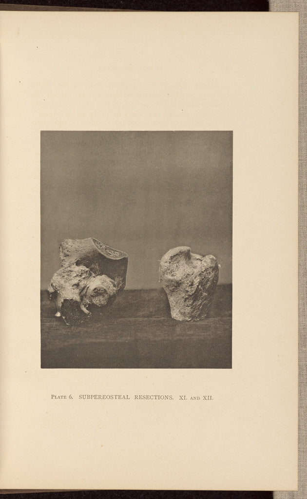 Charles B. Brigham:Subpereosteal Resections, Poster Print Wall Art