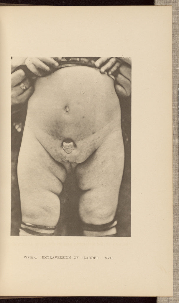 Charles B. Brigham:Extraversion of Bladder, Poster Print Wall Art