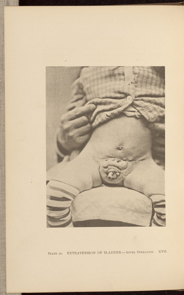 Charles B. Brigham:Extraversion of Bladder - After Operation, Poster Print Wall Art