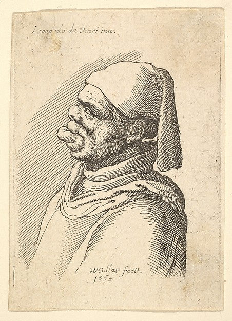 Bust of a deformed man with a hat and a fat  protruding lower,  Poster Print Wall Art