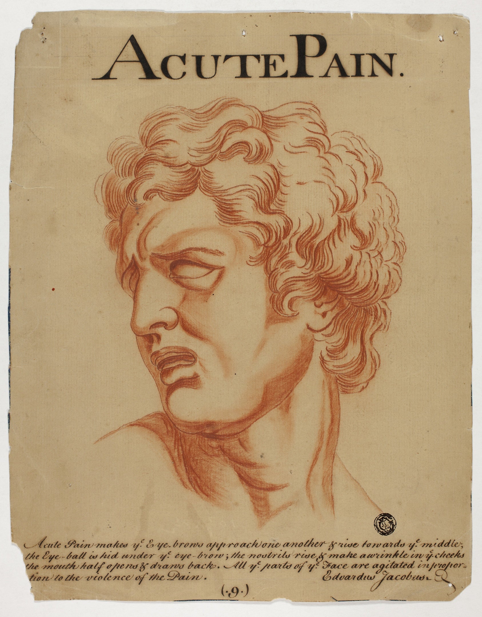 Acute Pain: Eduardus Jacobus (British, 18th century),16x12"(A3) Poster