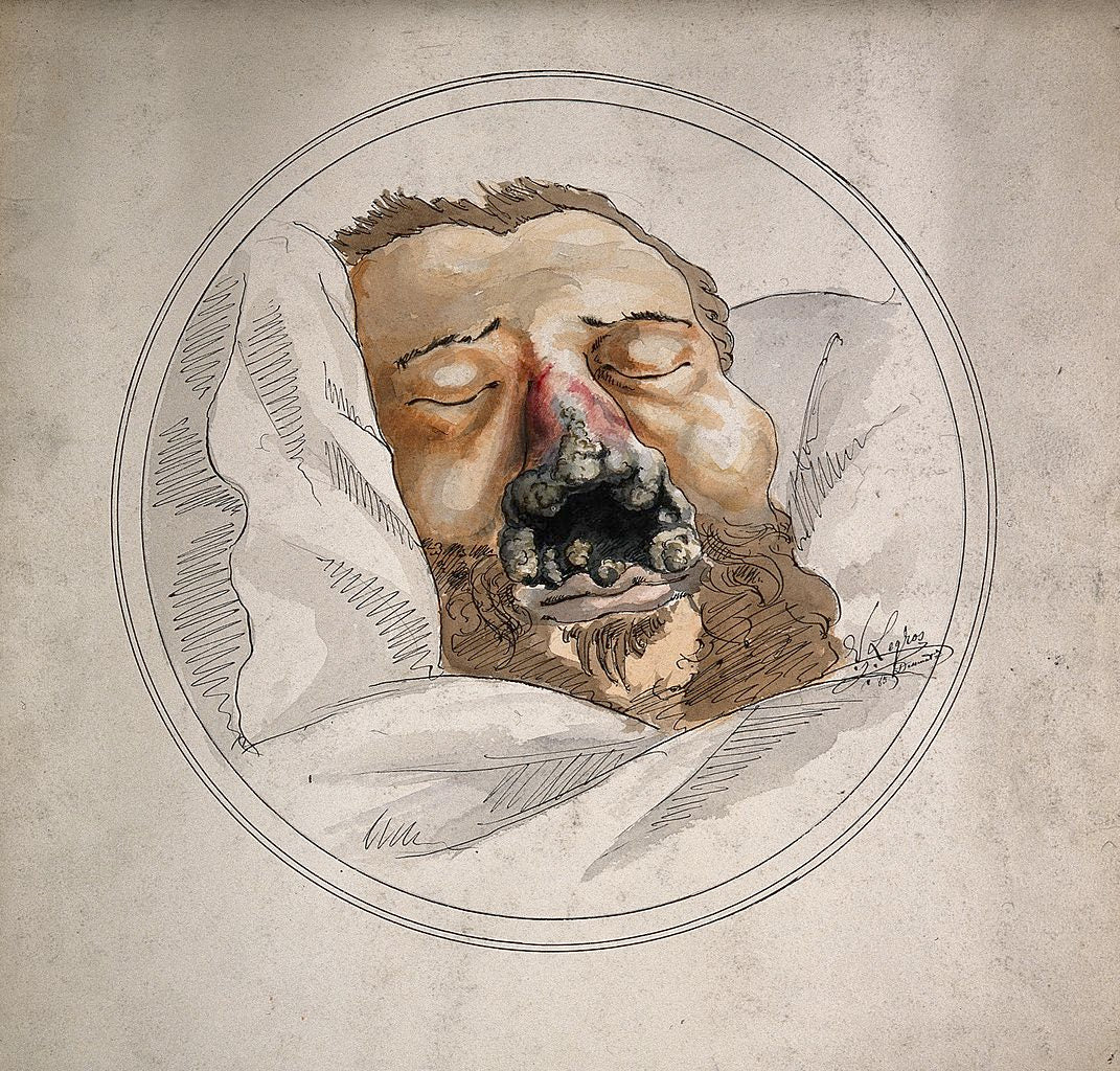 Eroded and Gangrenous Nasal Passage due to Syphillis, vintage artwork by Alphonse Legros, 12x8" (A4) Poster
