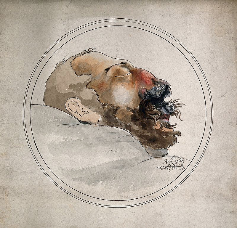 Syphilis:  Face of a Dead Man with Erosion of the Nose, vintage artwork by Alphonse Legros, 12x8" (A4) Poster