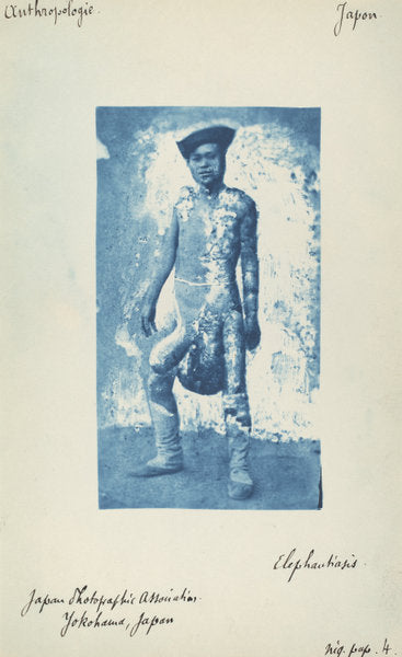 c. 1870s by Unknown 19th Century (Elephantiasis), 16X12"(A3)Poster Print