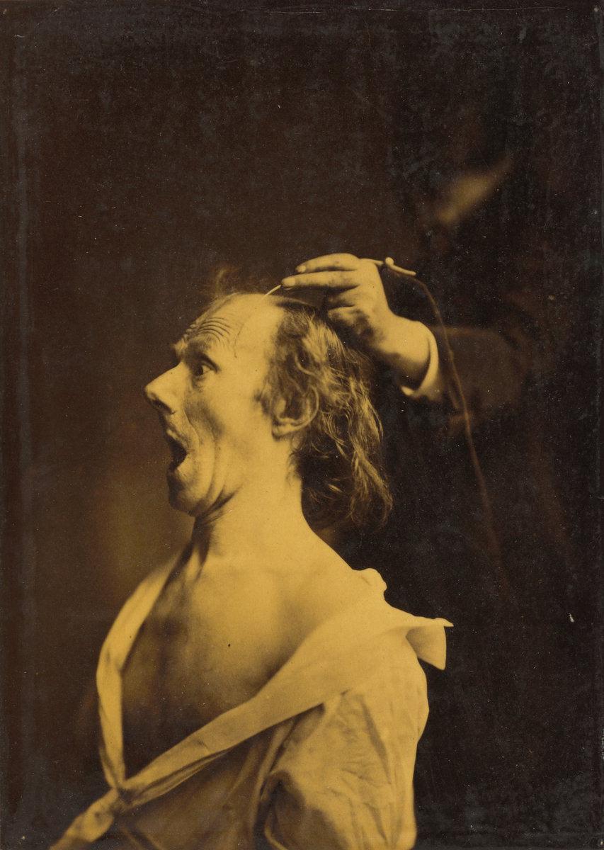 Astonishment, stupefaction, amazement by Guillaume-Benjamin-Amant Duchenne (de Boulogne) (French, 1806 - 1875), 16X12"(A3)Poster Print