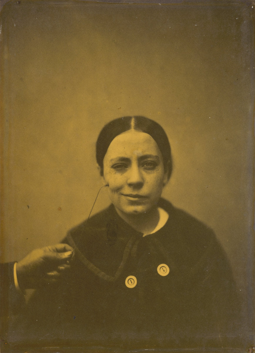 Slight lowering of the angle of the mouth due to depression (left); False laughter (right) by Guillaume-Benjamin-Amant Duchenne (de Boulogne) (French, 1806 - 1875), 16X12"(A3)Poster Print