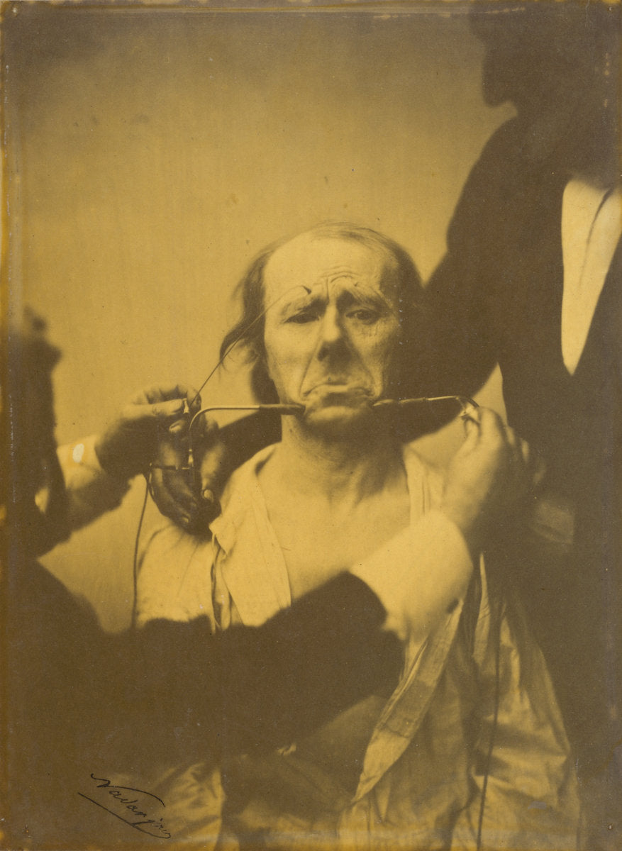 Pain and despair by Guillaume-Benjamin-Amant Duchenne (de Boulogne), French, 1806 - 1875, and Adrien Tournachon, French, 1825 - 1903 (French, 1806 - 1875), 16X12"(A3)Poster Print
