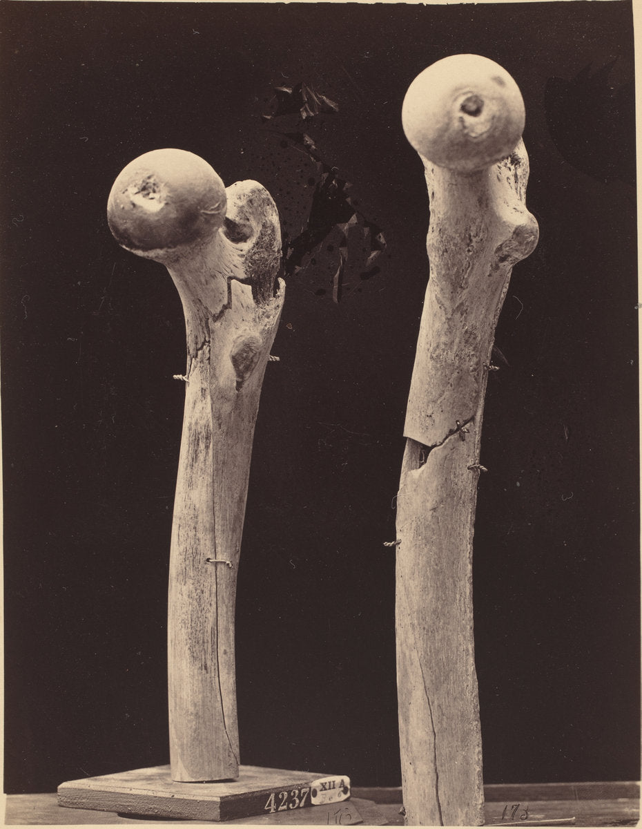 c. 1867 by American 19th Century (Specimens of Gunshot Fractures of the Femur), 16X12"(A3)Poster Print